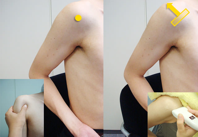 図　肩関節の観察法　棘上筋・棘下筋の観察の基本肢位(肩関節軽度伸展位)