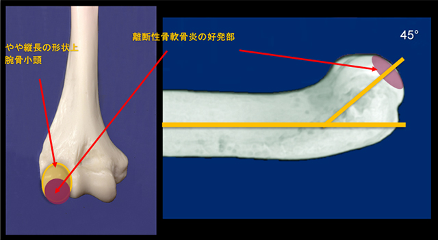図　上腕骨小頭の解剖学的構造