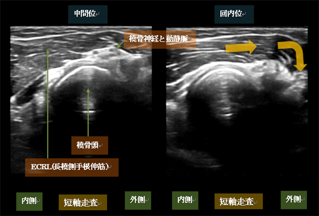 図　橈骨頭レベルでの回内動作の観察とECRL(長橈側手根伸筋)のふるまい