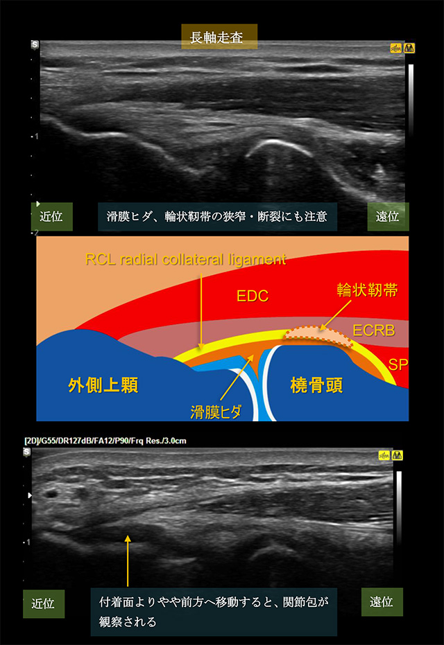 図　ECRB付着部と滑膜ヒダ、輪状靭帯、滑液包にも注意