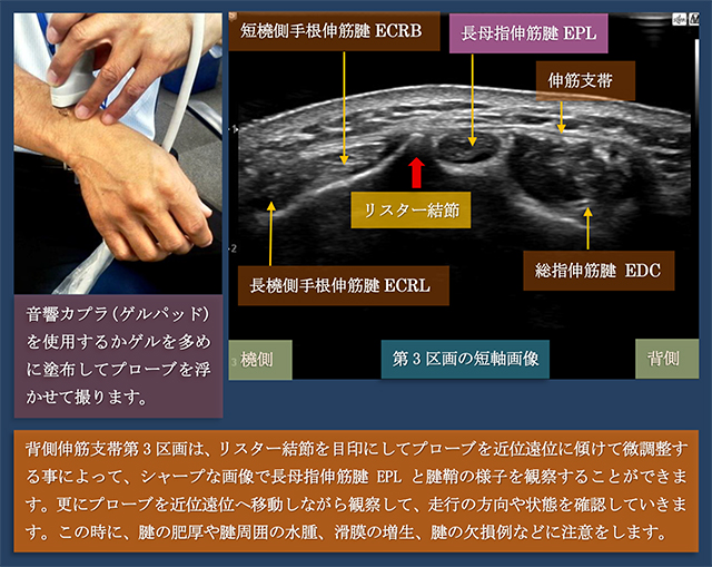 図　第3区画　長母指伸筋腱の超音波観察法　短軸走査