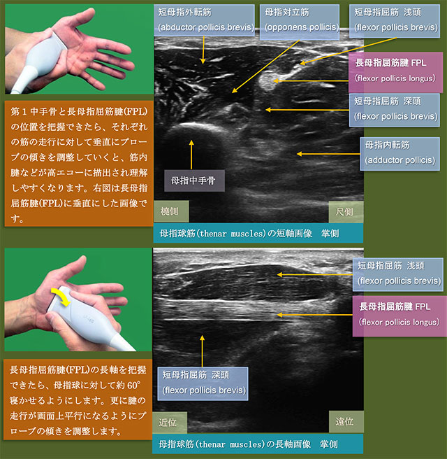 図　母指球筋(thenar muscles)と長母指屈筋腱(FPL)の超音波観察法