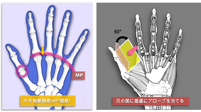 図　中手指節関節(MP関節)と母指MP関節でのプローブの角度