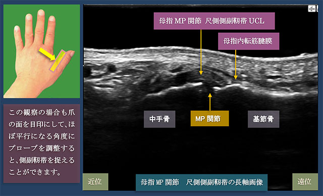 図　母指　MP関節　尺側側副靭帯(UCL)の長軸走査
