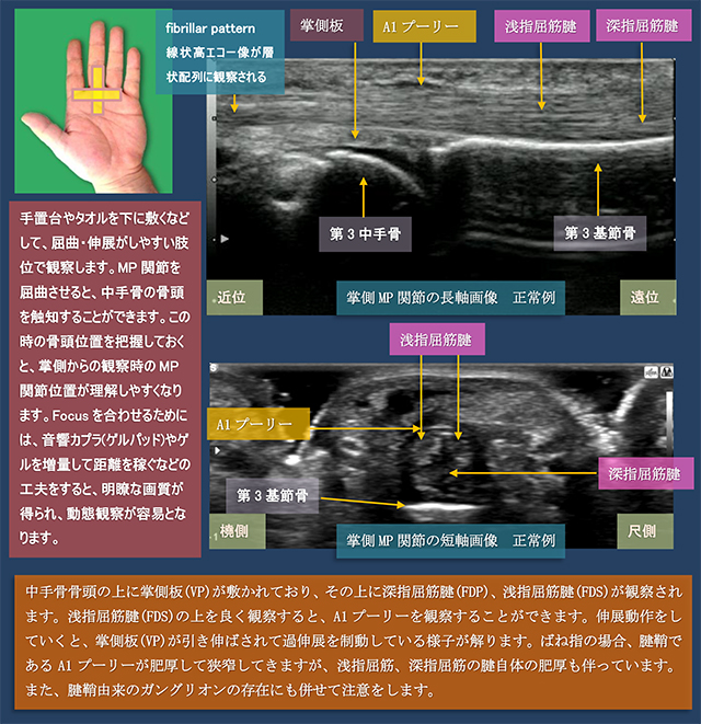 図　掌側からの浅指・深指屈筋腱とA1プーリーの超音波観察法(長軸・短軸)
