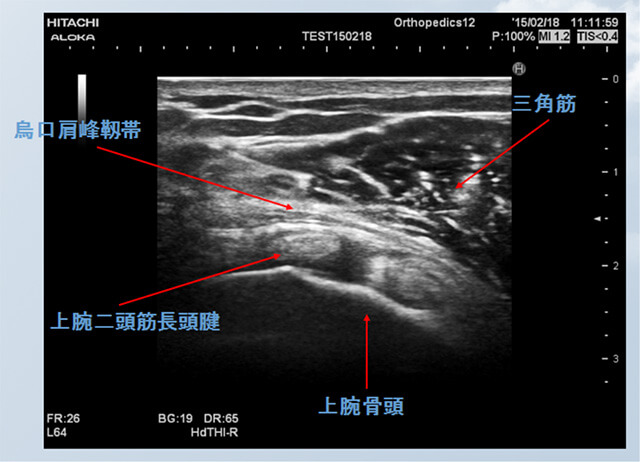 図　超音波で見る烏口肩峰靭帯と腱板、上腕骨頭