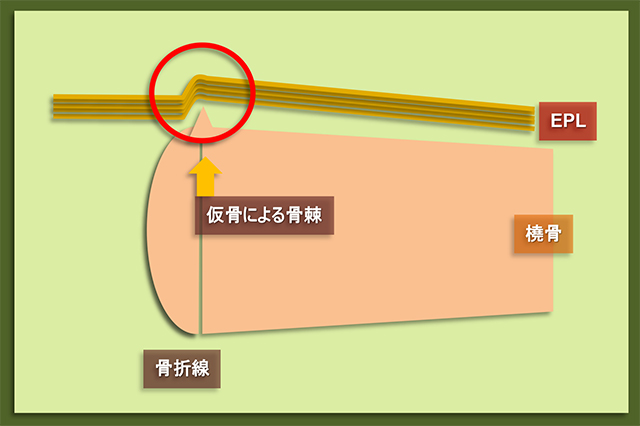 図　転位の少ない橈骨遠位端骨折後の骨棘形成