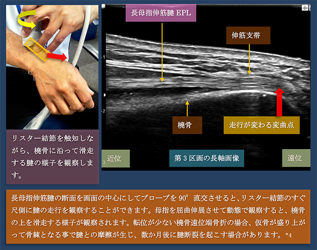 図　第3区画　長母指伸筋腱の超音波観察法　長軸走査