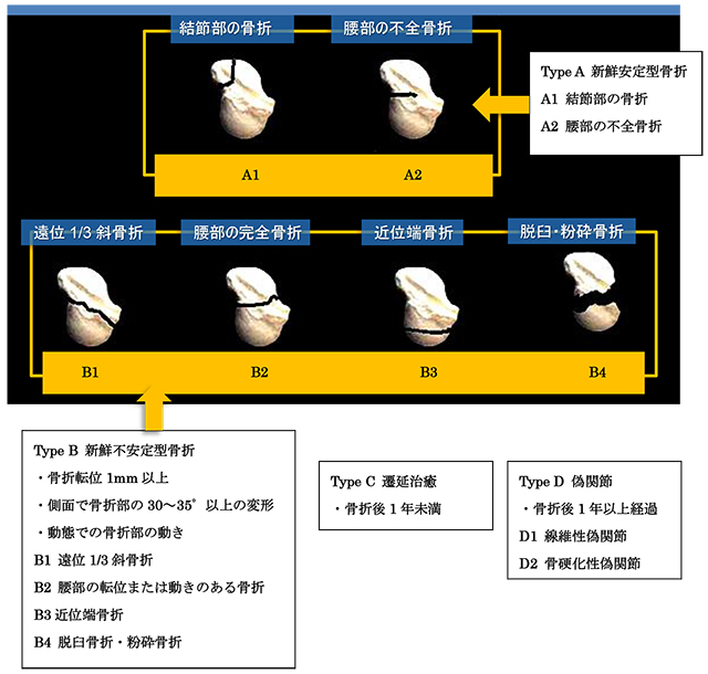 図　Herbert分類(Herbert classification)