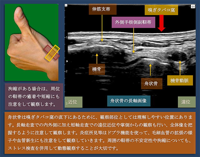 図　舟状骨の超音波観察　長軸走査