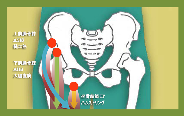 図　骨盤周囲の典型的な剥離骨折