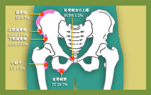 図　青年期の骨盤周囲の裂離骨折の部位と相対頻度