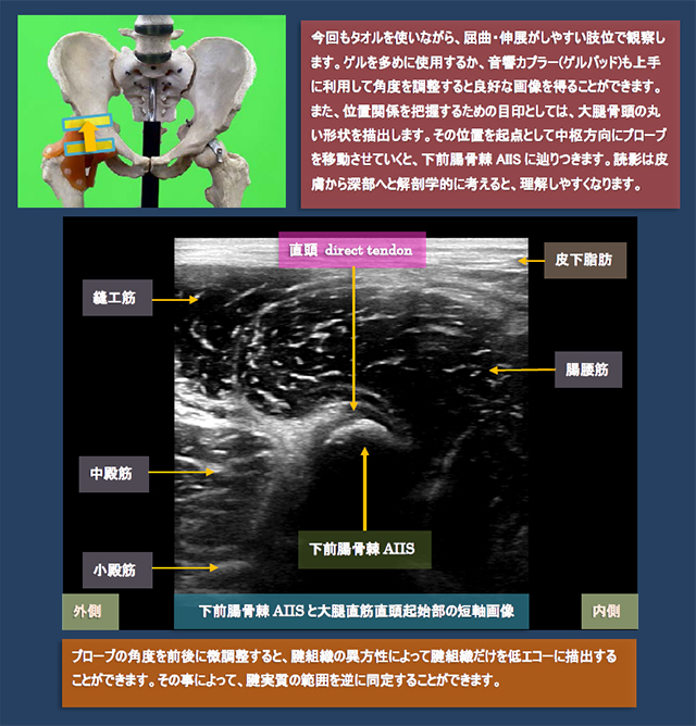 図　下前腸骨棘AIISと大腿直筋直頭起始部の短軸画像