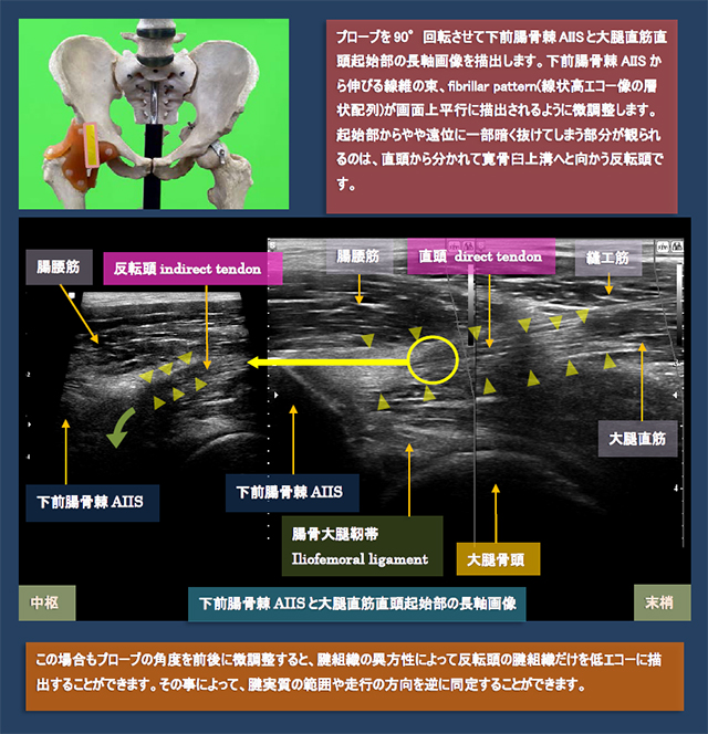 図　下前腸骨棘AIISと大腿直筋直頭起始部の長軸画像