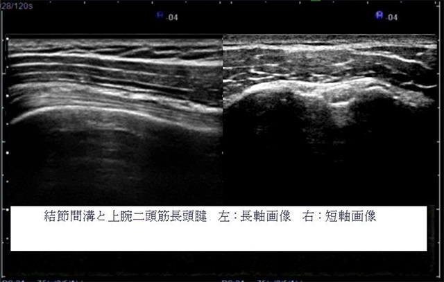 図　二画面表示機能による表示の例上腕二頭筋長頭腱の長軸短軸画像の比較