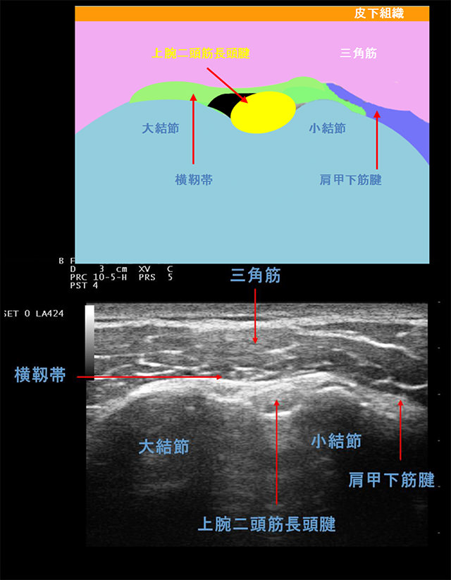 図　結節間溝と上腕二頭筋長頭腱　健常例　(短軸画像)　左 : 外側、右 : 内側