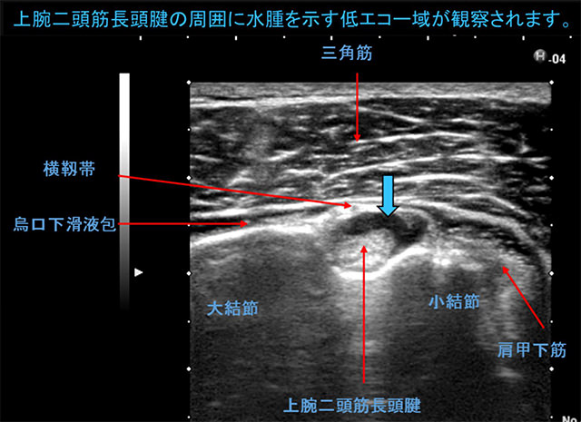 図　参考画像　関節水腫と烏口下滑液包内水腫