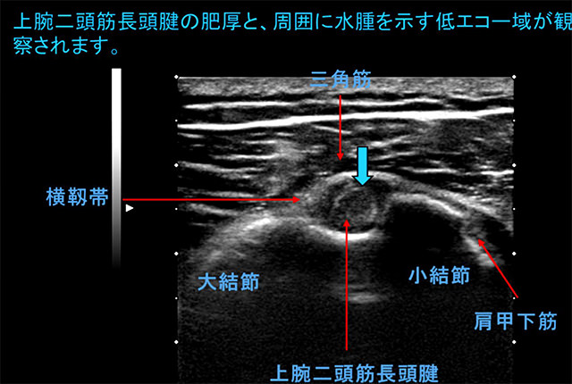 図　参考画像　上腕二頭筋長頭腱の肥厚