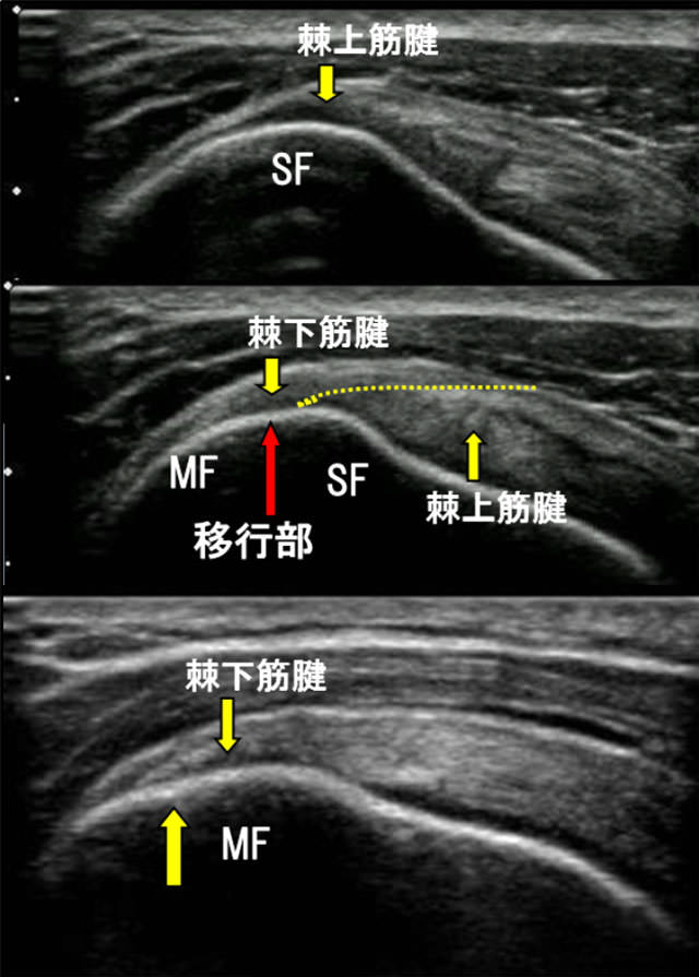 図　棘上筋・棘下筋の観察　長軸走査で前方から後方へ