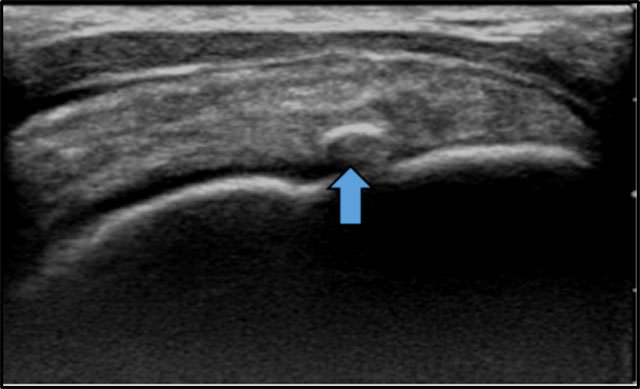 図　腱板内の高エコー像　石灰の存在を示唆