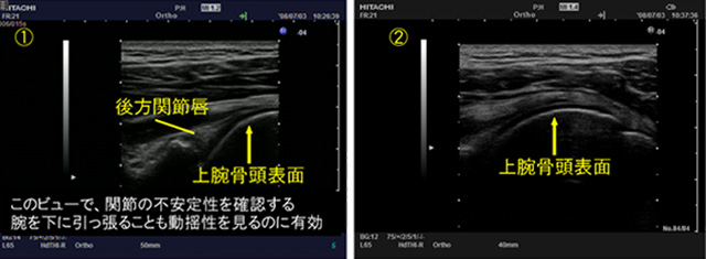 図　超音波で見る、関節窩と後方関節唇、上腕骨頭