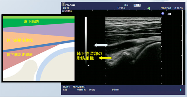 図　超音波で見る脂肪の広がりと、関節窩と後方関節唇、上腕骨頭