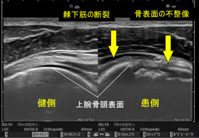 図　上腕骨頭軟骨面の観察　Hill-Sachs Lesion