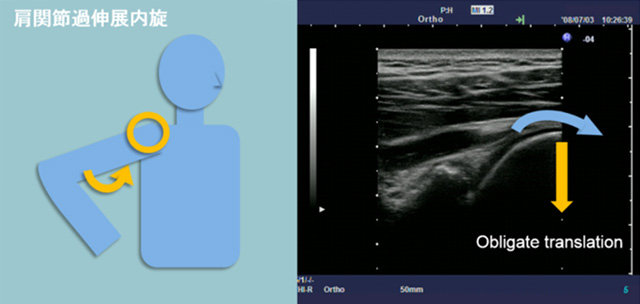 図　肩関節過伸展内旋動作に伴うobligate translation現象