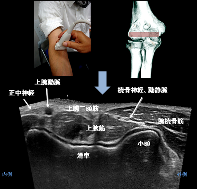 図　肘関節の観察法　前方アプローチ　上腕骨遠位端　短軸画像