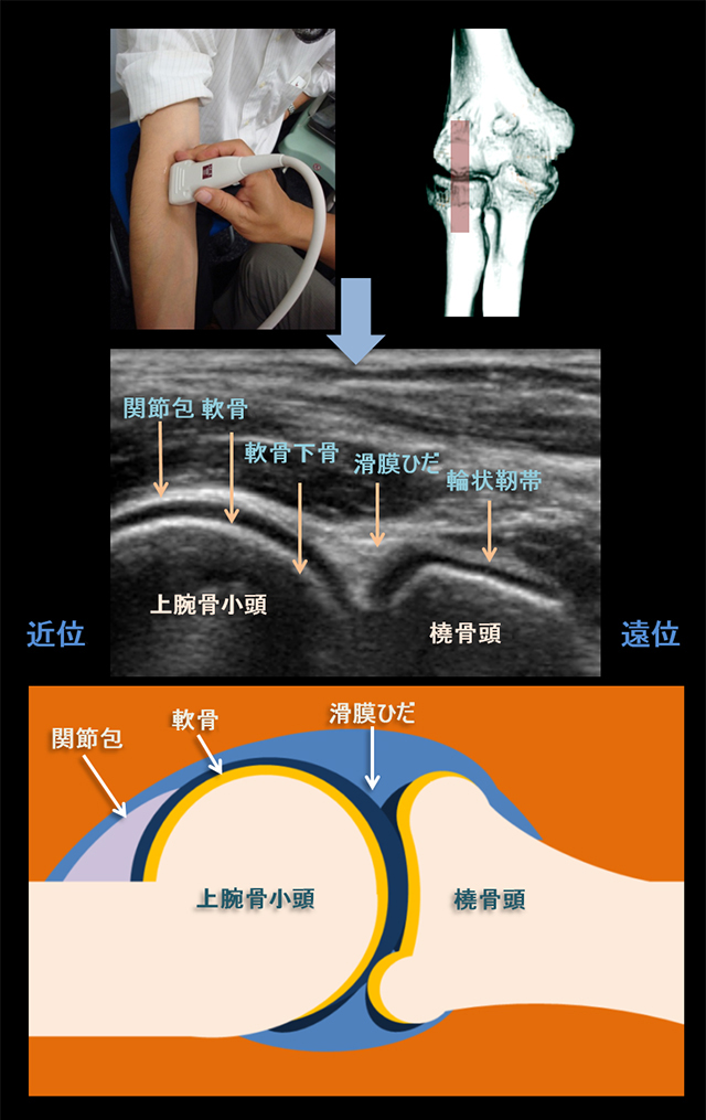 図　肘関節の観察法　前方アプローチ　長軸画像