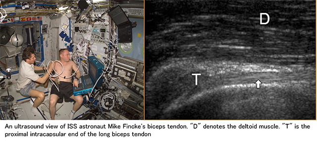 国際宇宙ステーションで肩関節を観ている宇宙飛行士と、上腕二頭筋長頭腱の超音波画像