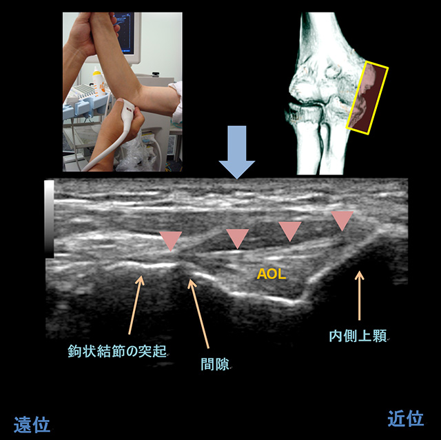 図　肘関節の観察法　内側アプローチ　内側側副靭帯　前斜走線維　長軸画像