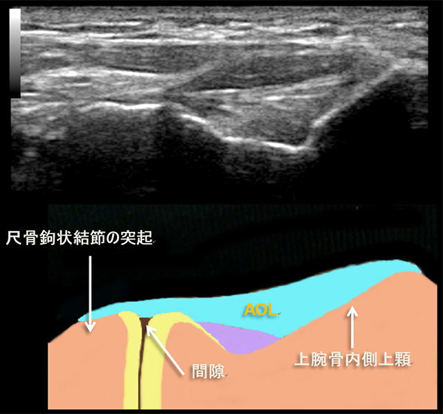 図　上腕骨内側上顆と尺骨鈎状結節、前斜走線維(AOL)