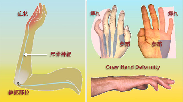 図　肘部管症候群(cubital tunnel syndrome)