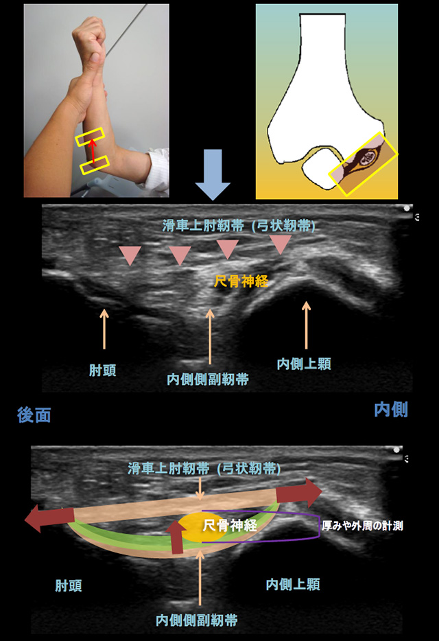 図　肘関節の観察法　内側アプローチ　尺骨神経　内側側副靭帯