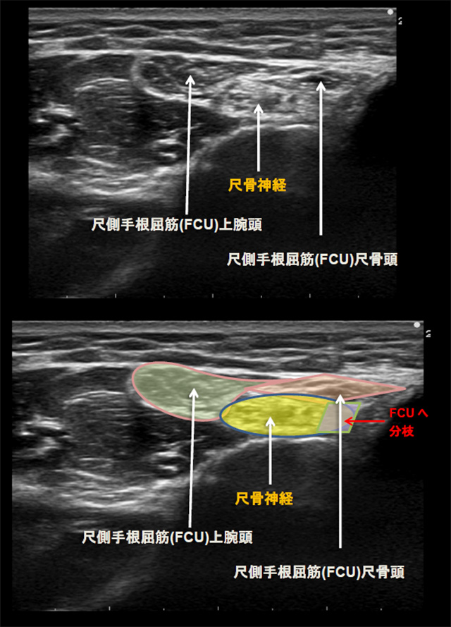 図　尺骨神経と尺側手根屈筋(FCU)上腕頭、尺骨頭