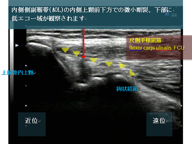 図　野球肘の進行過程としてまず観ておきたい
内側側副靭帯の観察法の復習