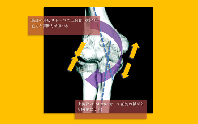 図　外反力による上腕骨小頭への圧迫力と剪断力の加わり方