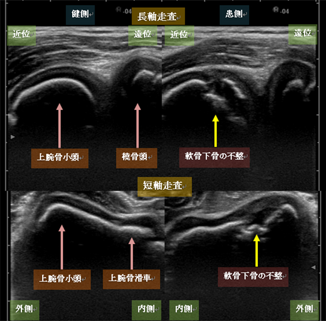 図　上腕骨小頭の長軸走査と短軸走査