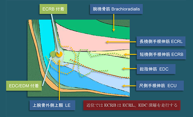 図　ECRBは外側上顆から橈骨頭付近まで腱性の組織