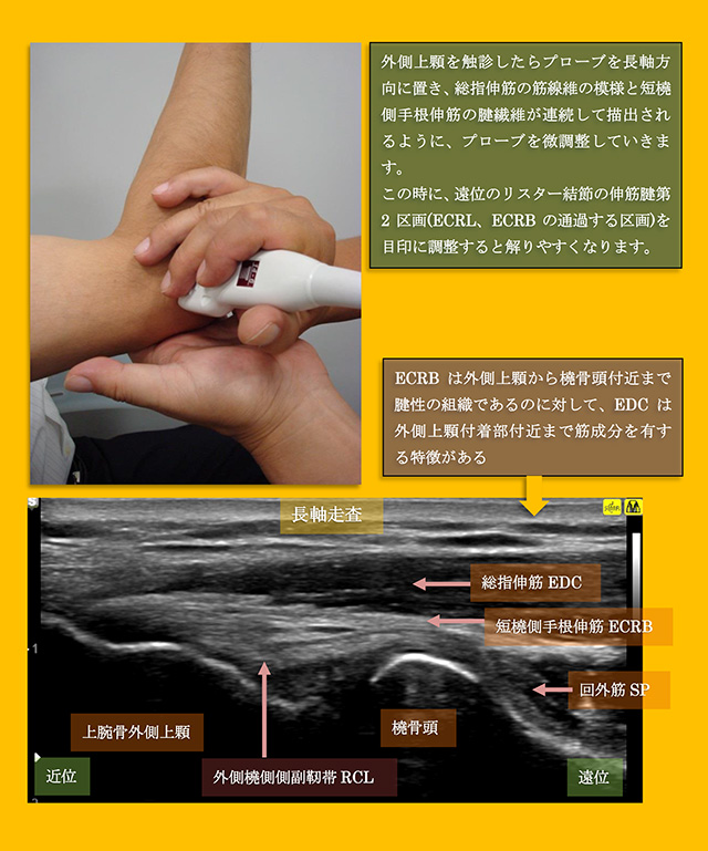 図　上腕骨外側上顆とECRBの長軸走査