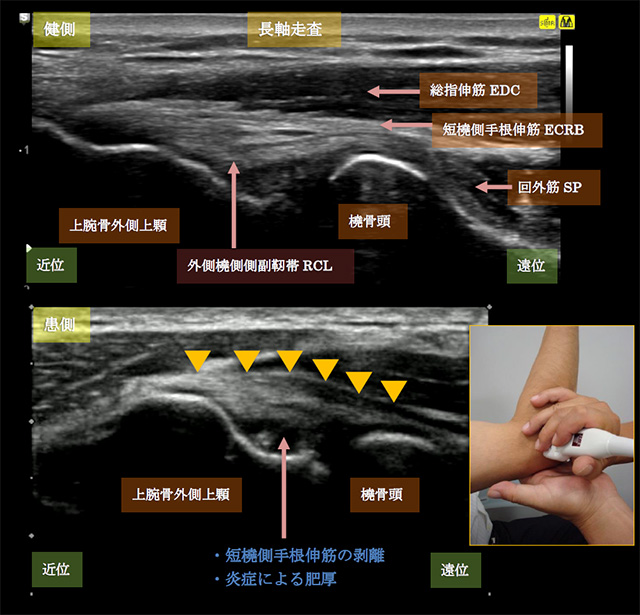 図　テニス肘(上腕骨外側上顆炎)の超音波による観察