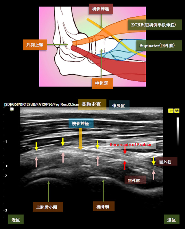 図　橈骨神経の長軸走査と回外筋入口(the arcade of Frohse)