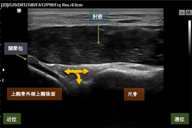 図　肘筋の観察法　長軸走査