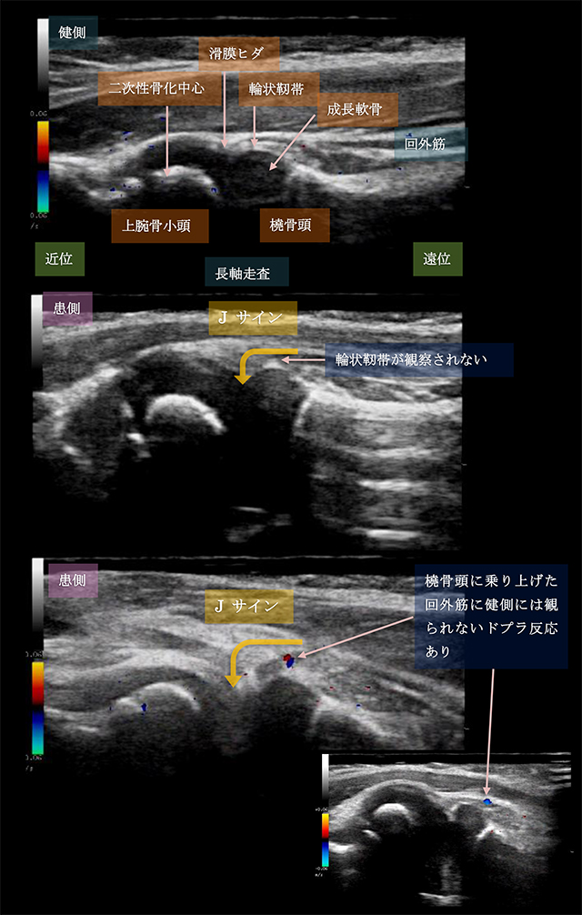 図　肘内障(Pulled elbow)の超音波観察法