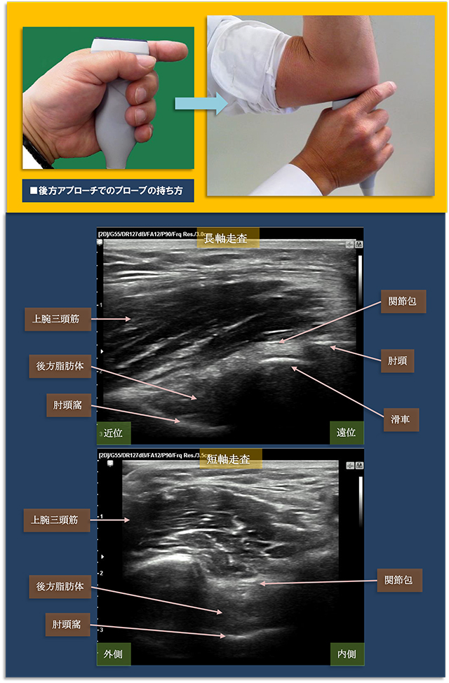 図　肘関節後方の超音波観察