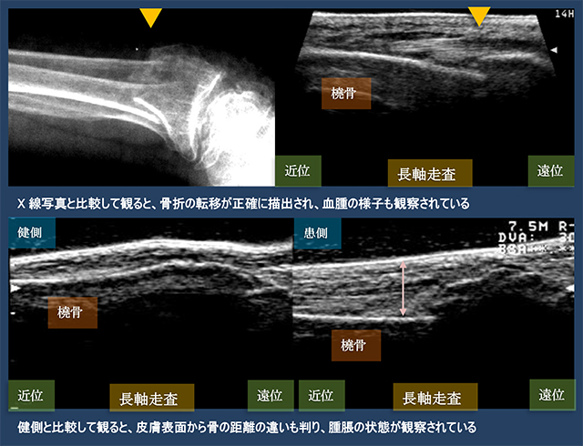 図　橈骨遠位端骨折のX線写真と健側との比較観察