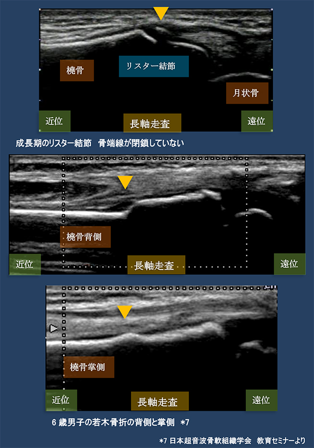 図　成長期の橈骨遠位端と若木骨折