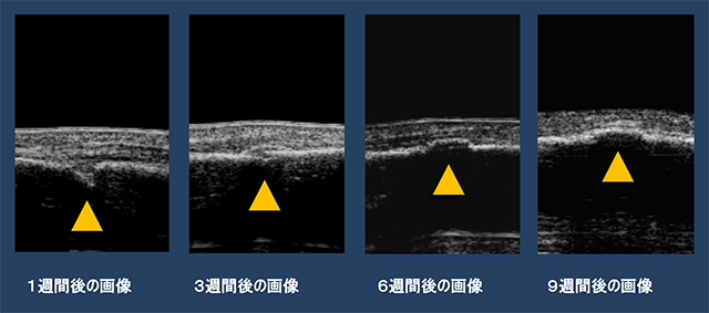 図　尺骨骨折の経過観察画像*9