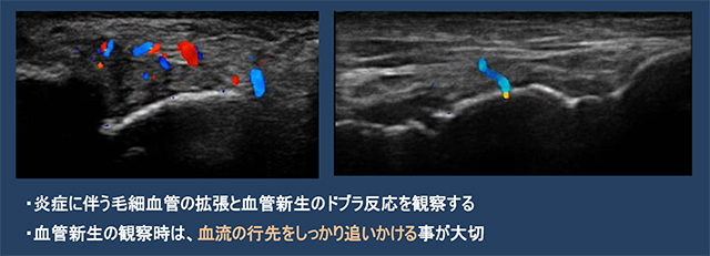 図　炎症と血管新生の観察例